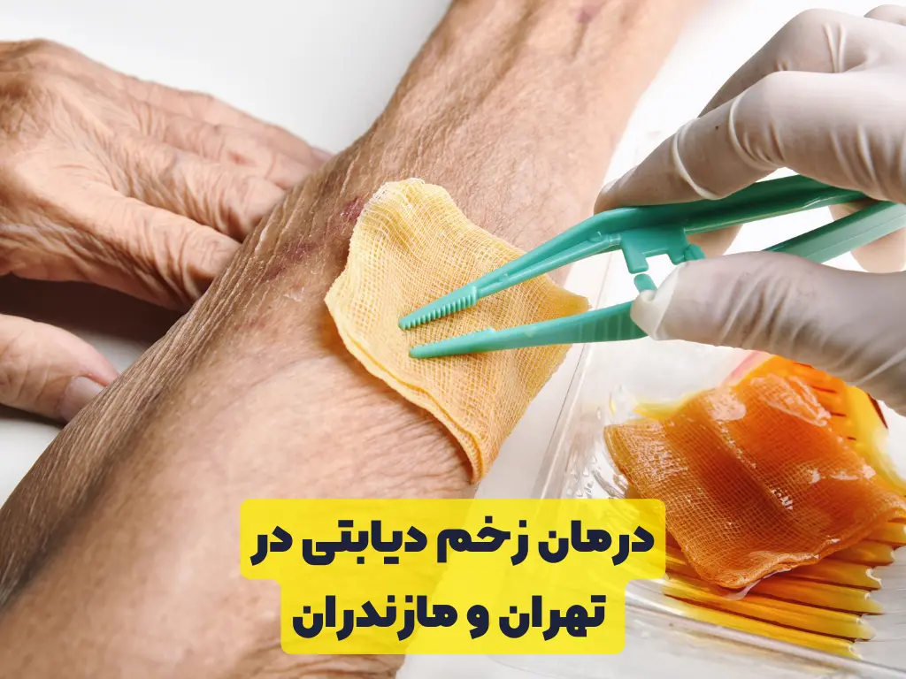 درمان زخم دیابتی در
 تهران و مازندران