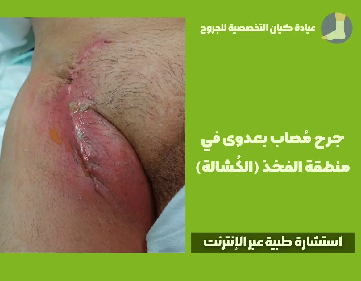 جرح مُصاب بعدوى في منطقة الفخذ (الكُشالة) – عيادة كيان التخصصية للجروح – استشارة طبية عبر الإنترنت