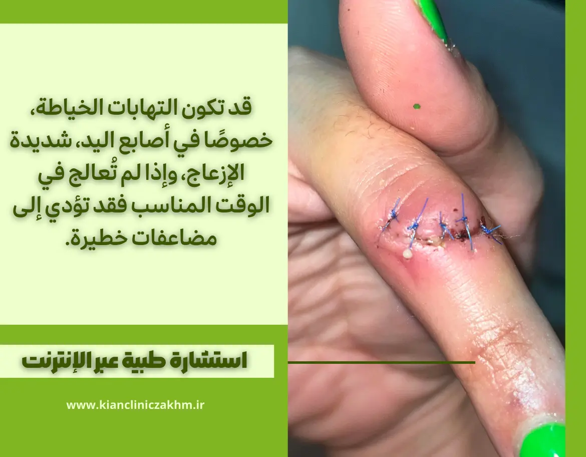 عدوى خياطة في إصبع اليد مع تورم وصديد – استشارة طبية عبر الإنترنت