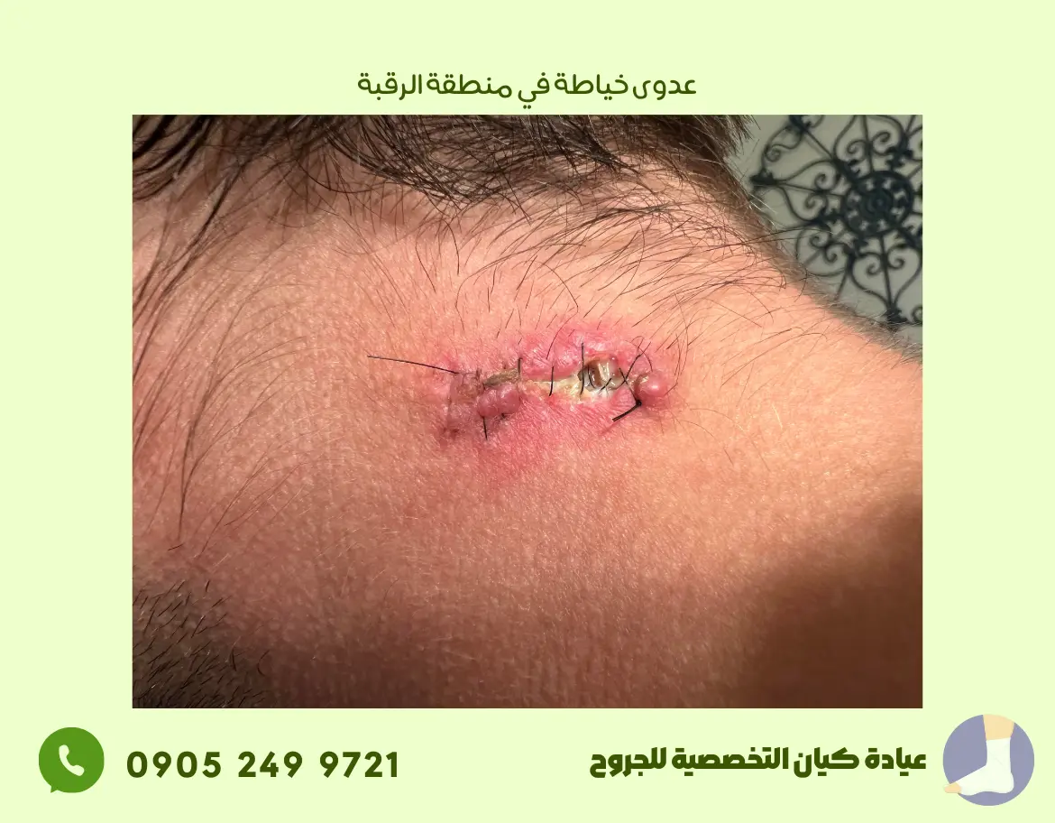 عدوى خياطة في منطقة الرقبة مع تورم وصديد – عيادة كيان التخصصية للجروح