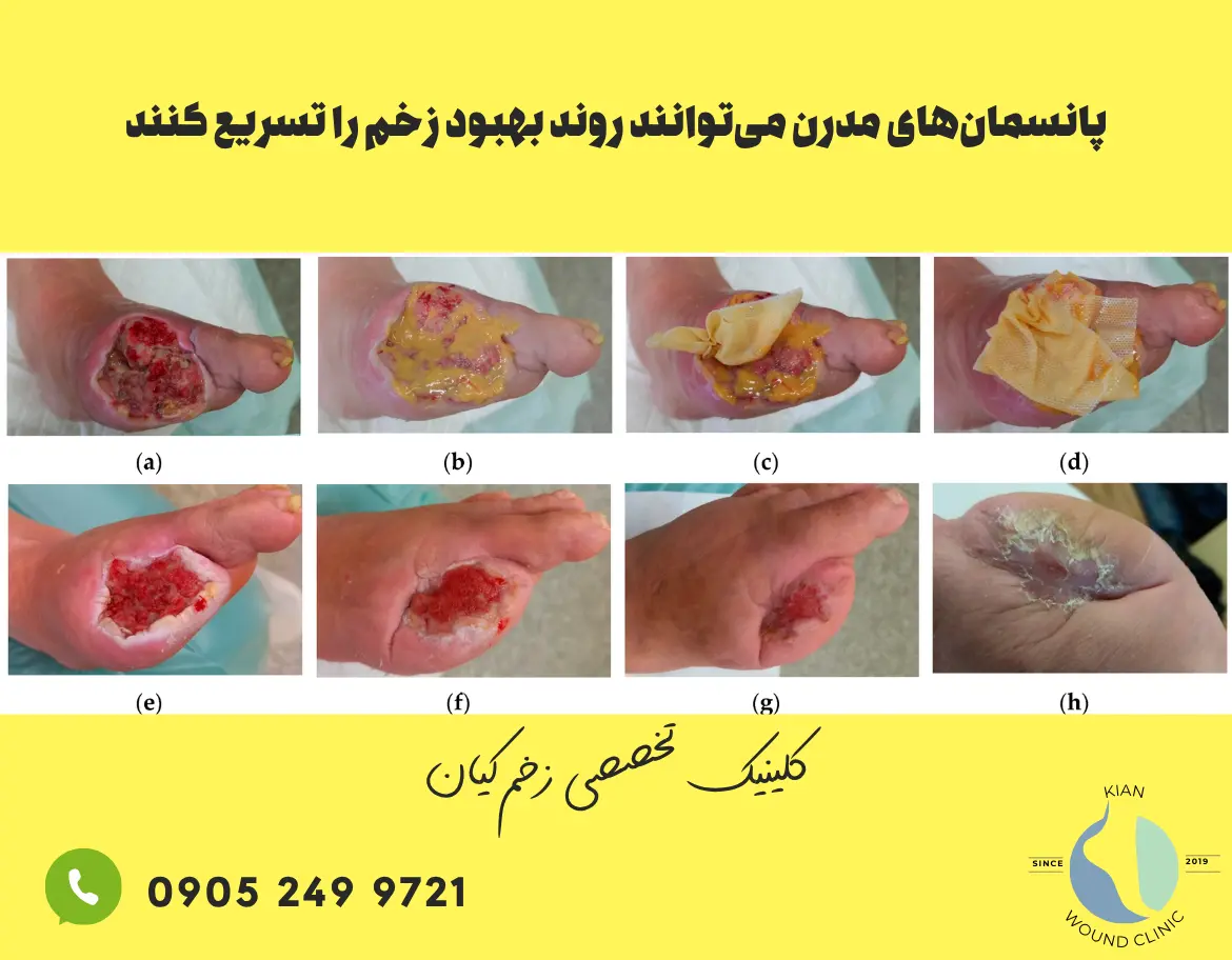 بهبود زخم با پانسمان پیشرفته بدون آنتی‌بیوتیک