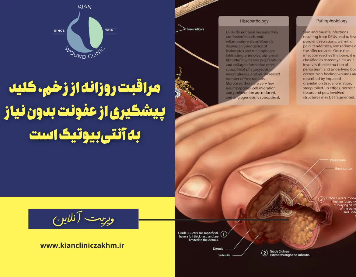 مراقبت از زخم با پانسمان پیشرفته بدون آنتی‌بیوتیک