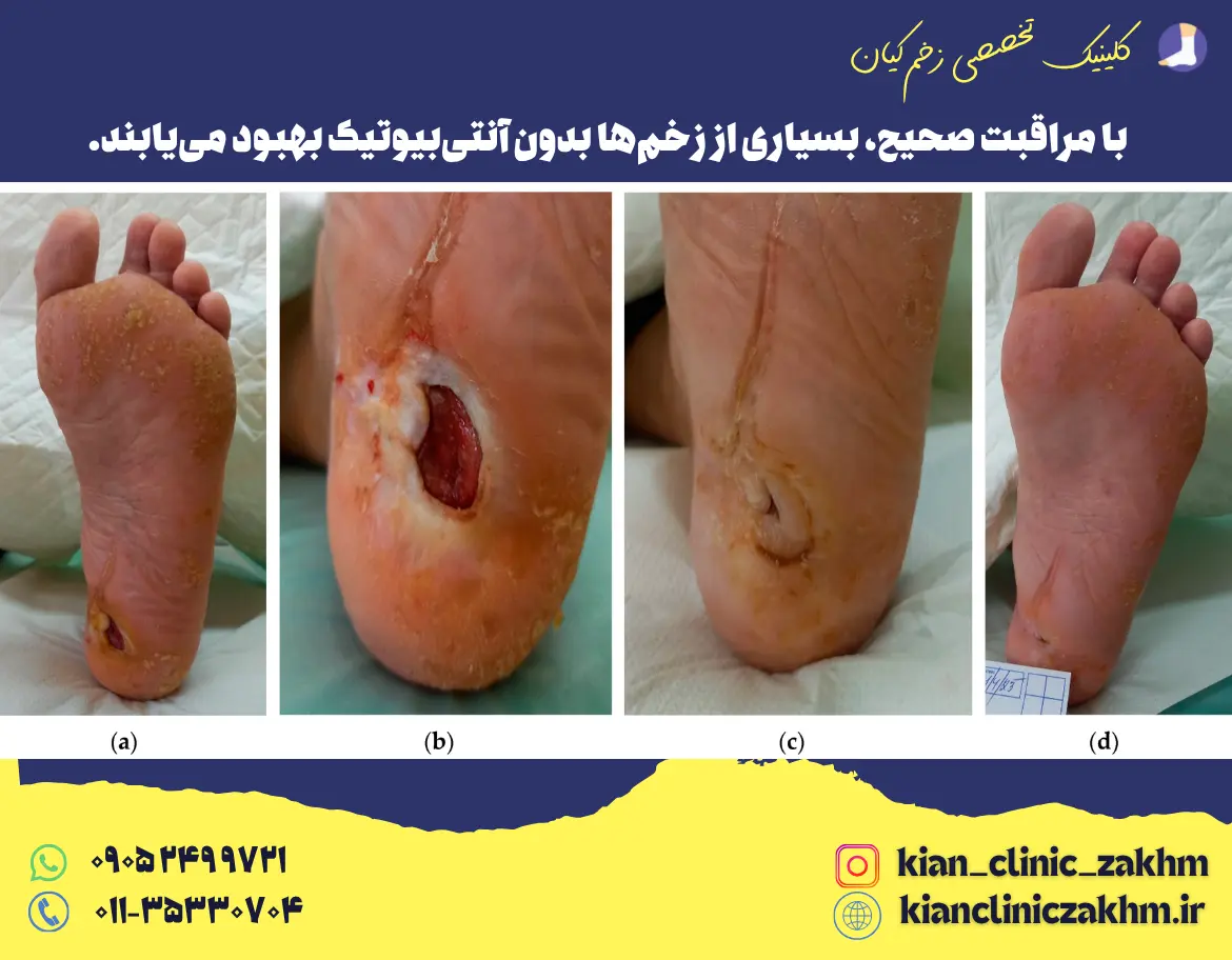 مقایسه زخم قبل و بعد از درمان بدون آنتی‌بیوتیک